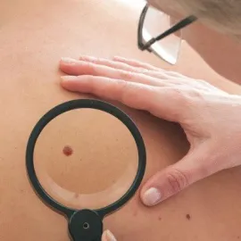 Melanom může zabíjet. Přehled míst na Ostravsku, kde vám zdarma vyšetří znaménka